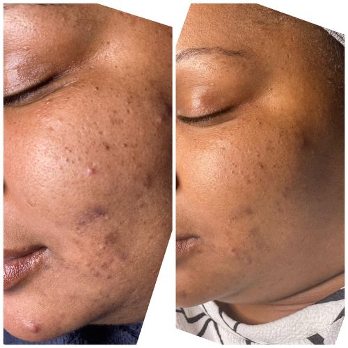 chemical-peel-before-and-after